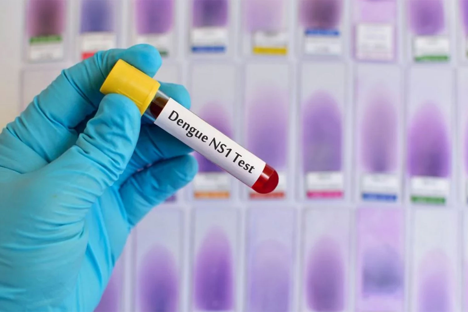 Nueva prueba en el Laboratorio: Antígeno NS1 para Dengue