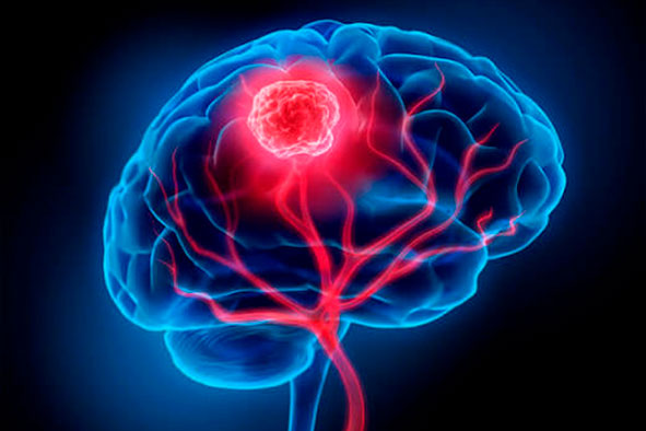 Un nuevo tratamiento controla el tumor en el 96% de pacientes con un tipo de cáncer cerebral